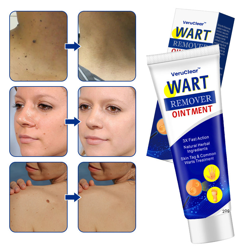 【Limited Stock Available】VeruClear™ Wart Remover Ointment