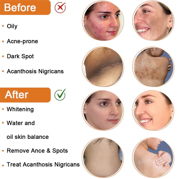 Skinenjoy™Cleansing Lotion for Acne & Spots & Acanthosis Nigricans